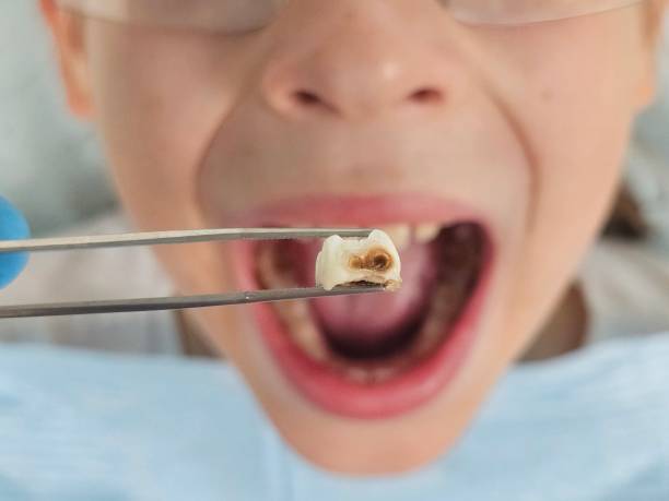 Best Emergency Care for Gum Disease in Montegut, LA